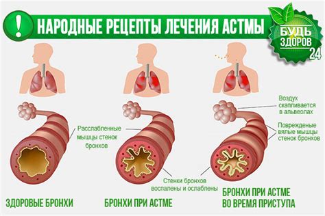 Использование народных средств в лечении мокроты при бронхиальной астме
