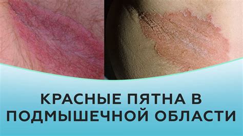 Как избавиться от зуда под левой подмышкой у женщин