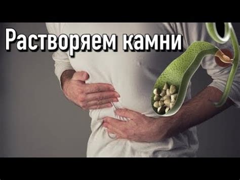 Как избавиться от камней желчного пузыря без операции: эффективные советы