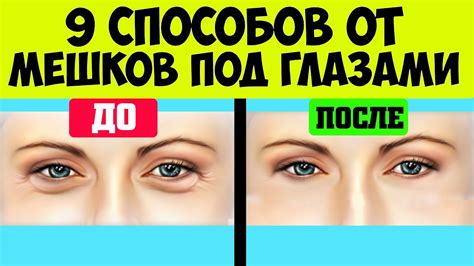 Как избавиться от мешков под глазами