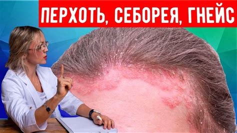Как лечить грибок на волосах