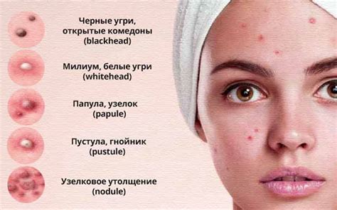 Как определить связь прыщей с глистами