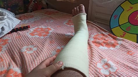 Как определить сломанную ногу