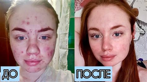 Как поддерживать кожу после удаления космофена