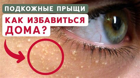 Как правильно прижигать подкожные прыщи йодом: шаг за шагом инструкция