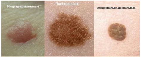Как правильно удалять родинку лазером дома