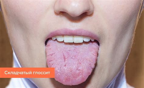 Как предотвратить и устранить мозоли на кончике языка