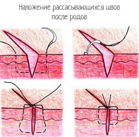 Как проходит снятие швов после кесарева сечения: советы и время восстановления