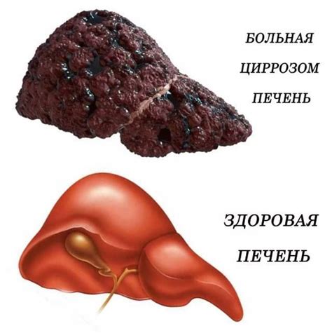 Как распознать цирроз печени