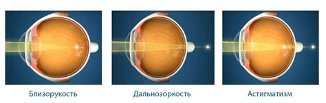 Как сохранить зрение после лазерной коррекции: полезные советы