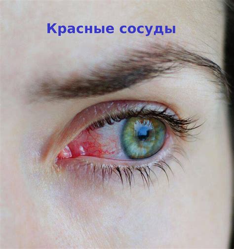 Как удалить красные капилляры на глазах