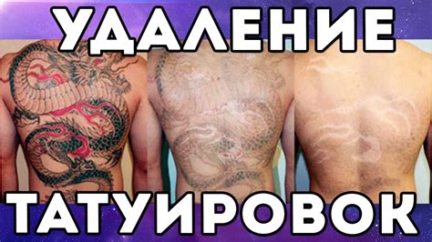 Как успешно удалить домашнюю игольчатую татуировку самостоятельно
