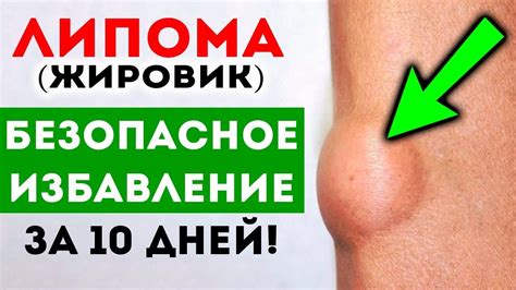 Как эффективно избавиться от жировика при помощи йода