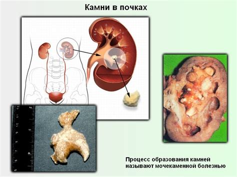 Камень в почке: эффективное лечение и методы обнаружения