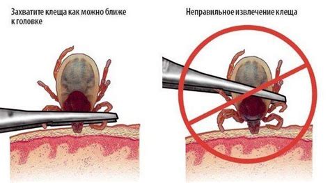 Клиническое удаление клеща