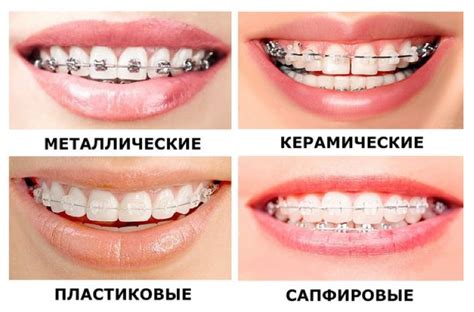 Когда возможно поставить брекеты повторно