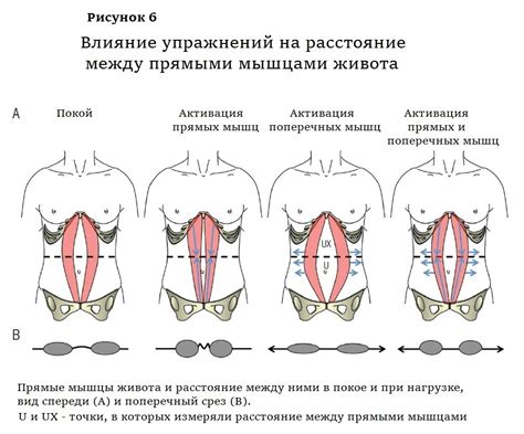 Компрессионные изделия для регулирования диастаза прямых мышц живота