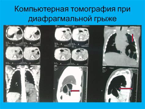 Компьютерная томография при хиатальной грыже