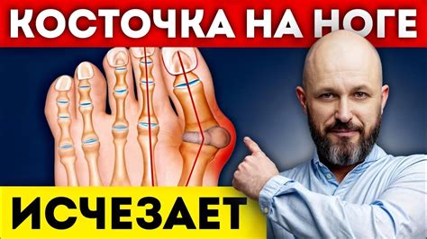 Косточка на ноге: причины и лечение