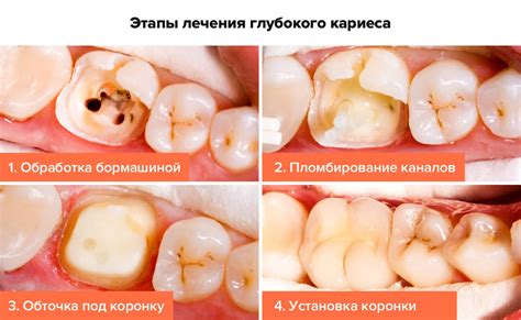 Лечение зубов и кариеса