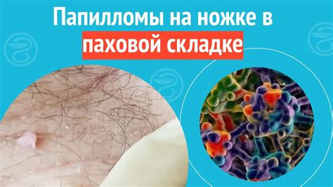 Лечение папилломы в паховой области домашними средствами: преимущества и особенности