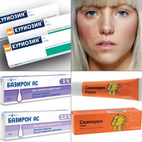 Лечение прыщей в натуральной медицине