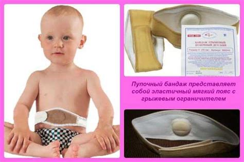 Лечение пупочной грыжи у двухлетнего ребенка