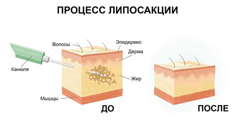 Липосакция: эффективное хирургическое вмешательство