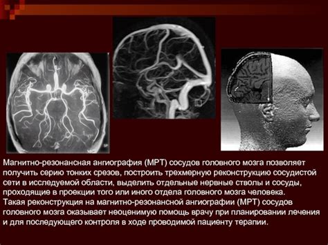 Магнитно-резонансная ангиография головного мозга