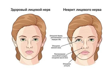 Медикаментозные методы восстановления нерва в ухе