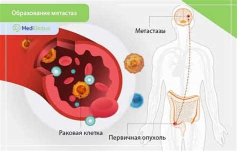 Метастазирование опухоли