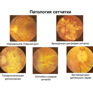 Методы восстановления сетчатки глаза
