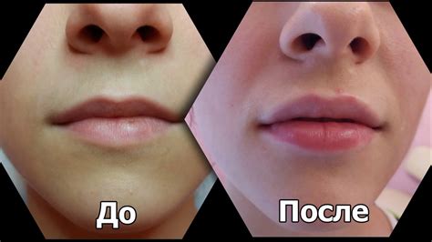Методы и процедуры для удаления гиалуронки