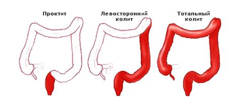 Методы лечения колик внизу живота