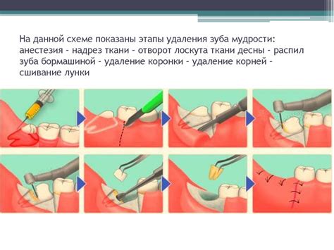 Методы удаления флюса с десен при помощи специальных инструментов