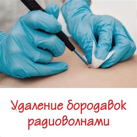 Метод "от околоскальпельной бородавки до кончика"