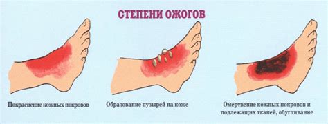 Метод проверки натуральности кожи с помощью огня