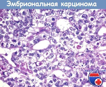 Механизмы развития эмбриональной загубленности