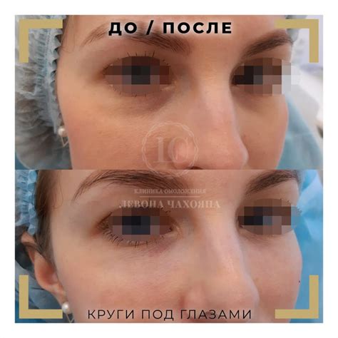 Мешки под глазами у женщин