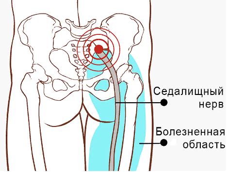 Мовалис в лечении защемления седалищного нерва