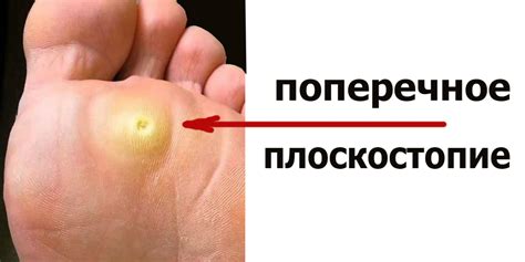 Мозоли и натоптыши как причина боли в пальцах ног