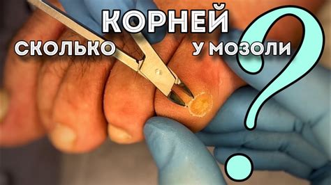 Мозоль на мизинце: эффективные способы лечения