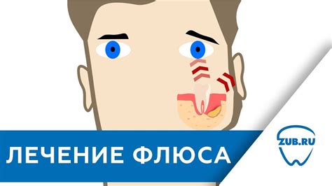 Народные способы удаления флюса с десен: эффективные рецепты и рекомендации