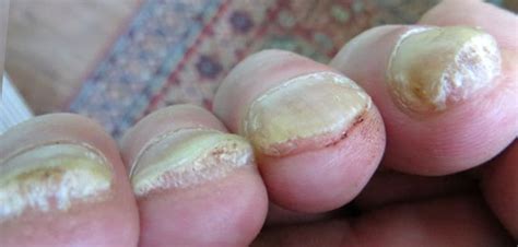 Натуральные средства для борьбы с твердыми ногтями