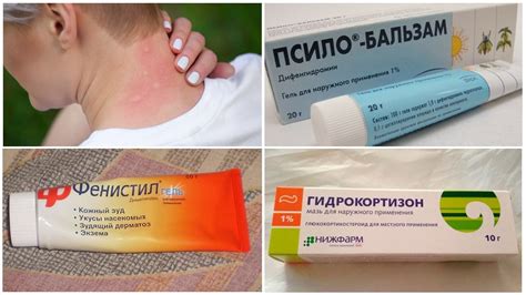 Натуральные средства от чесотки после укуса комара