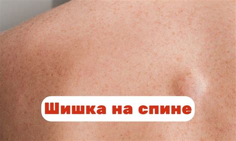 Необычные способы избавления от шишки на языке