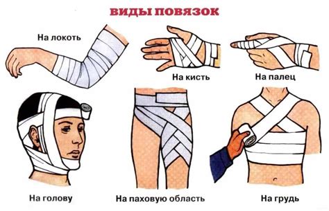 Неправильное наложение фиксирующих гаек