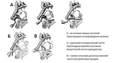 Неправильное положение носа
