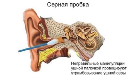 Низкая гигиена ушей