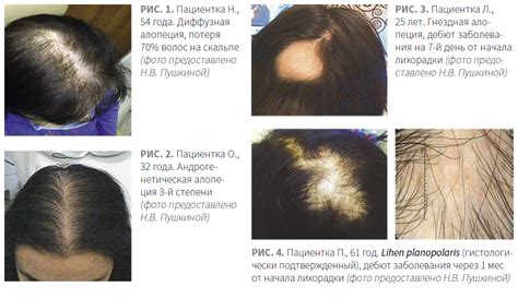 Облысение и сбой волосяного роста: причины и факторы